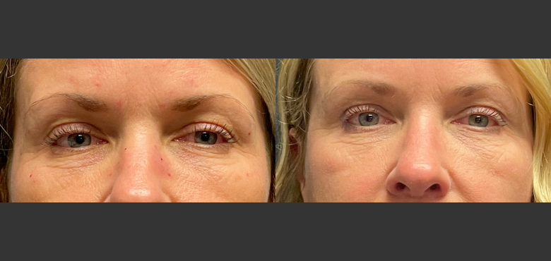 Before and after bilateral extended temporal brow lift, lower lid blepharoplasty with fat transposition and skin pinch (1)
