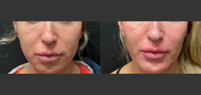 Buccal fat pad removal (3)