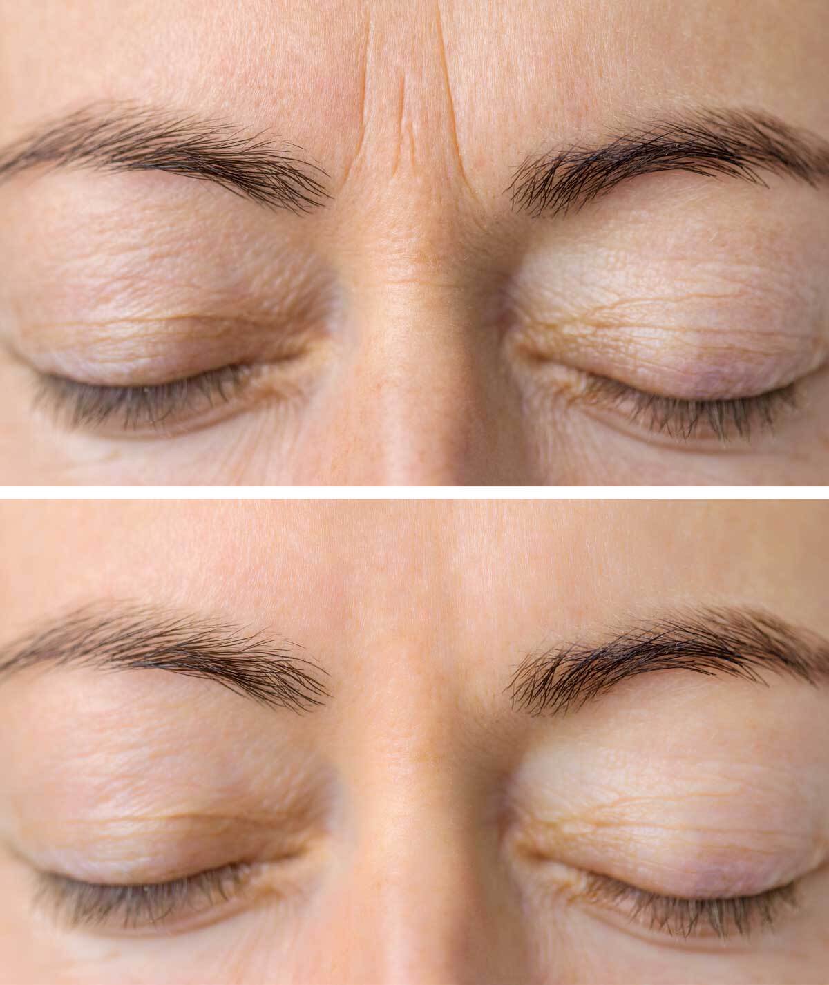 Get Rid of Forehead Wrinkles