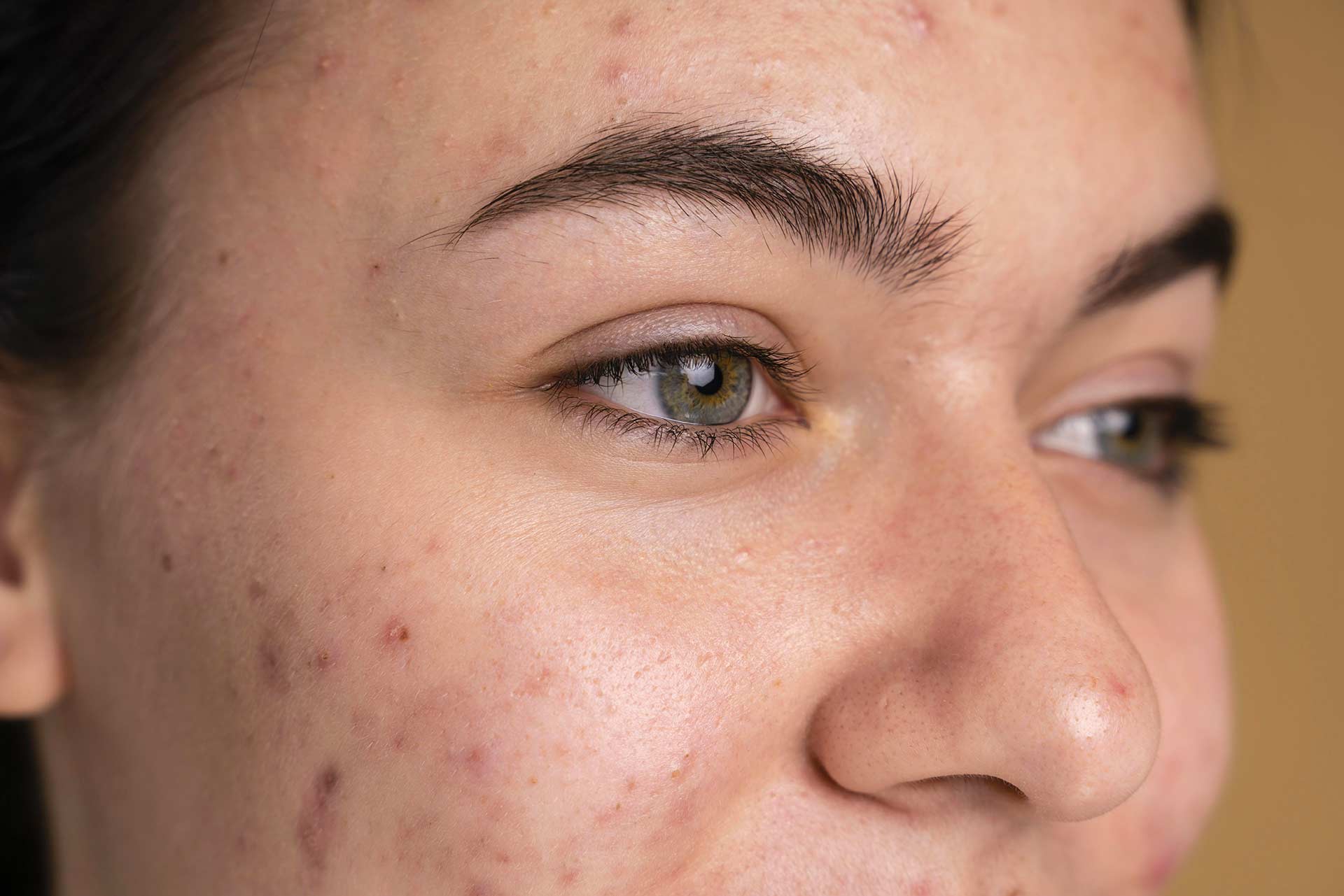 How to Get Rid of Acne Scars