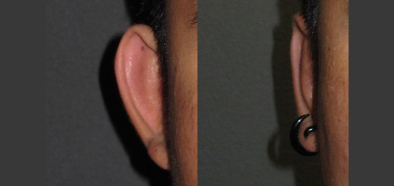 Ear-Surgery-1