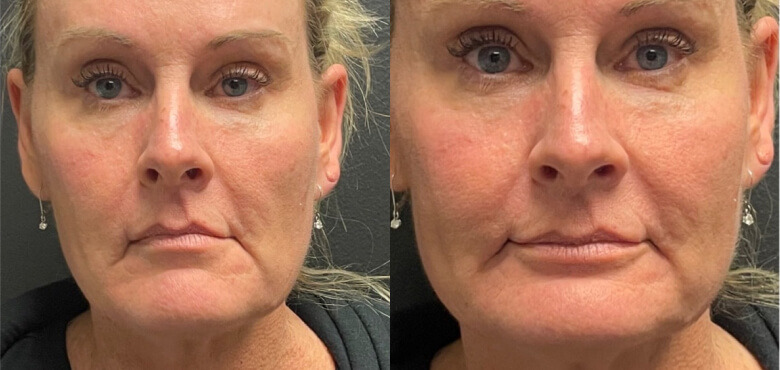 Face and neck lift (1)