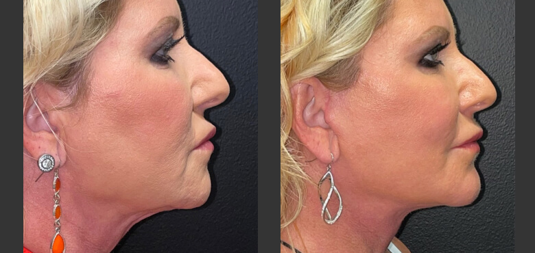 Face and neck lift (2)