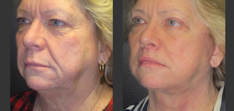 Face and neck lift (3)