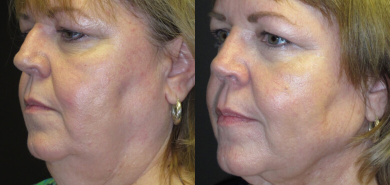 Face and neck lift (5)
