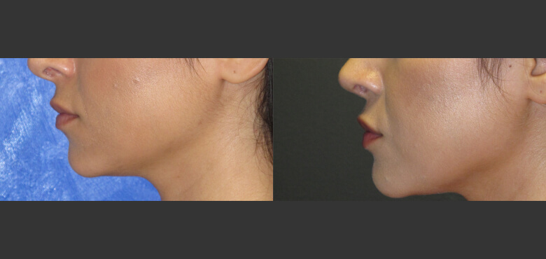 Facial Implants (1)