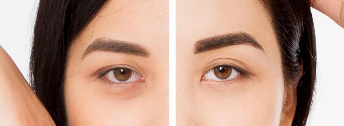 Brow Lift bakersfield