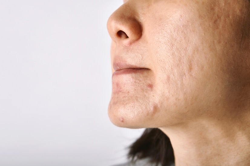 laser for acne scars