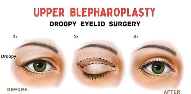 In-Office Blepharoplasty in Bakersfield