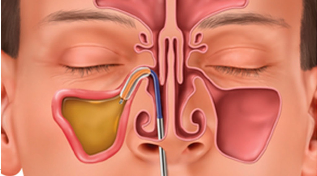 In-Office Balloon Sinuplasty in Bakersfield: Experience the Ease of Sinus Relief with Dr. Fisher